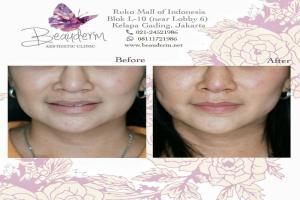 Tarik Benang (Threadlift)